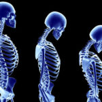princ_rm_photo_of_stages_of_osteoporosis